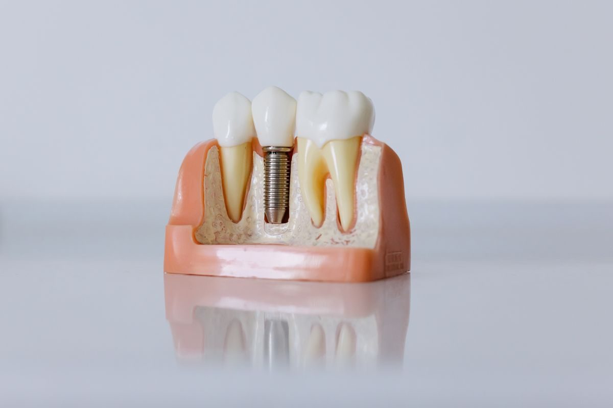 Modelo de implante dental mostrando el tornillo colocado en el hueso, entre dientes naturales