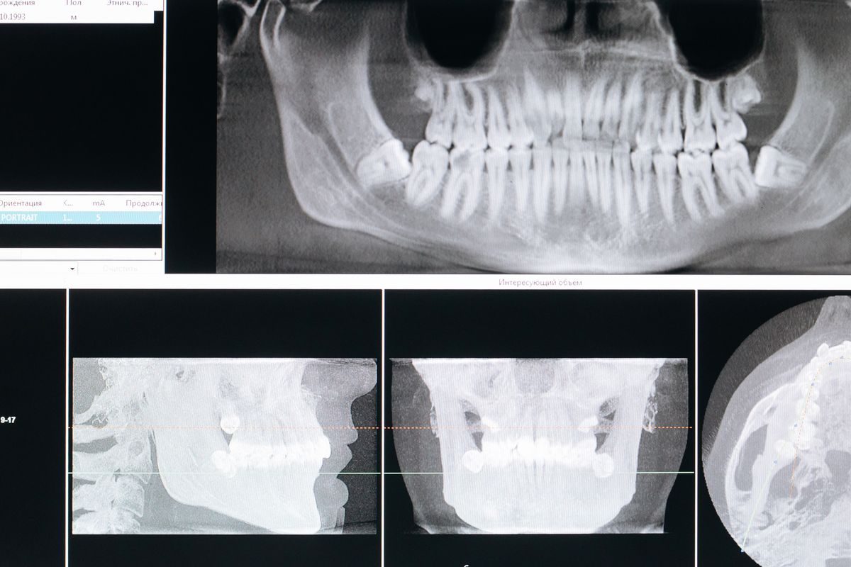 Radiografía panorámica dental mostrando la posición de las muelas del juicio